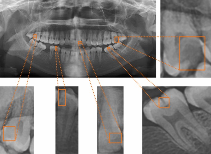 An enhanced deep learning model for detection and classification of ...