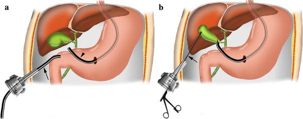 транслюминальная аппендэктомия. дренаж после операции желчного пузыря. лапароскопическая операция на желчном пузыре. холецистит и лапароскопическая холецистэктомия. эндоскопическая литоэкстракция.