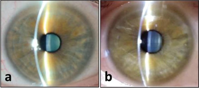 A smartphone attachment for remote ophthalmic slit lamp examinations |  SpringerLink