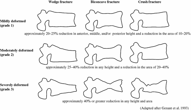 The Prognosis For Pain Disability Activities Of Daily Living And Quality Of Life After An Acute Osteoporotic Vertebral Body Fracture Its Relation To Fracture Level Type Of Fracture And Grade Of Fracture The Prognosis For Pain Disability Activities Of Daily Living And Quality Of Life After An Acute Osteoporotic Vertebral Body Fracture Its Relation To Fracture Level Type Of Fracture And Grade Of Fracture