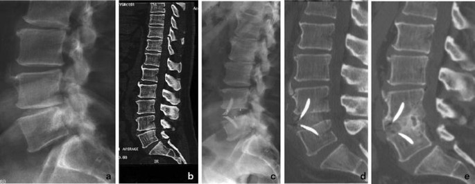 Stand-alone ALIF with integrated intracorporeal anchoring plates in the  treatment of degenerative lumbar disc disease: a prospective study on 65  cases | SpringerLink