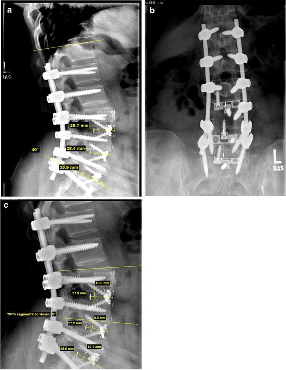 Radiological evaluation of anterior lumbar fusion using PEEK cages with  adjacent vertebral autograft in spinal deformity long fusion surgeries |  SpringerLink
