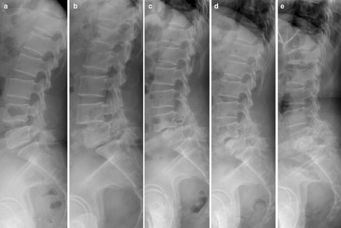 Rheumatoid Arthritis-Associated Spinal Neuroarthropathy With Double-Level  Isthmic Spondylolisthesis | Springerlink