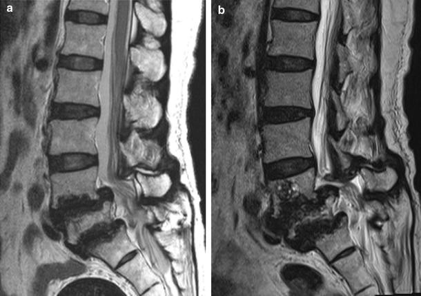 Rheumatoid Arthritis-Associated Spinal Neuroarthropathy With Double-Level  Isthmic Spondylolisthesis | Springerlink