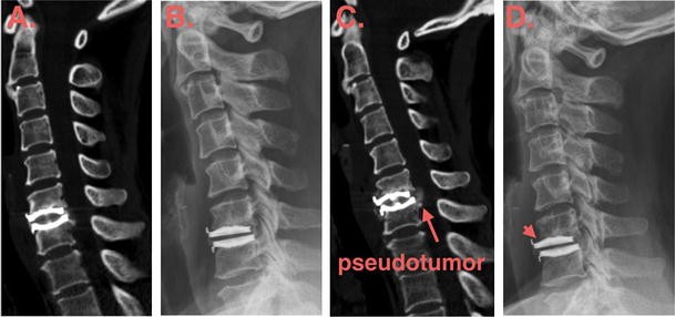 Metallosis after traumatic loosening of Bryan cervical disc arthroplasty: a  case report and literature review | SpringerLink