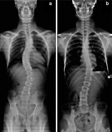Lowered dose full-spine radiography in pediatric patients with idiopathic  scoliosis | SpringerLink