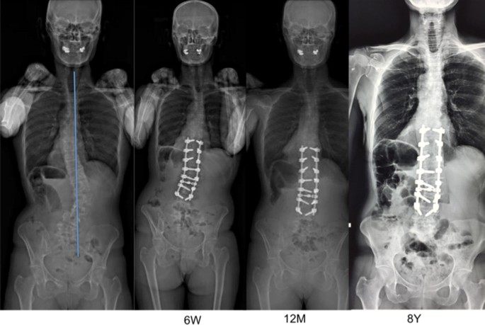 showing dorso lumbar scoliosis with anterior breaking at D12, L1,2