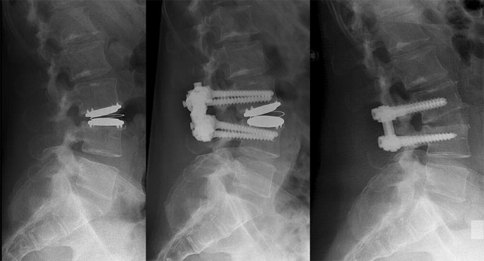 Long-Term Clinical Outcome Of Two Revision Strategies For Failed Total Disc  Replacements | Springerlink