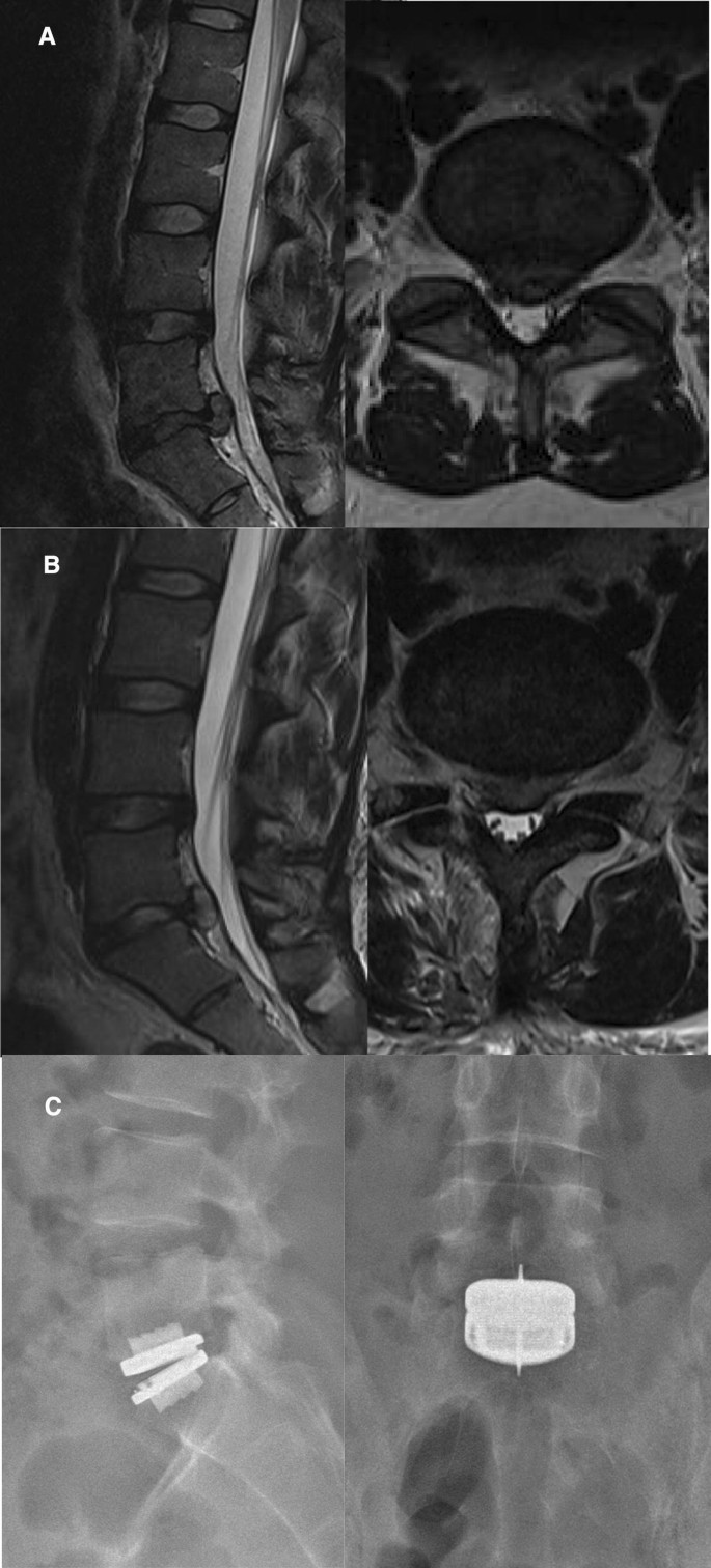 microdiscectomy scar