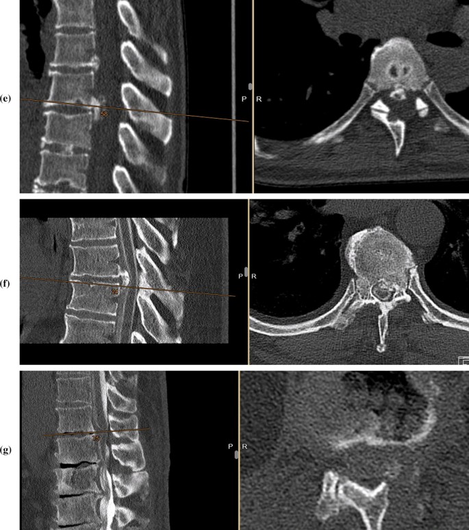 Revision Surgery In Thoracic Disc Herniation Springerlink