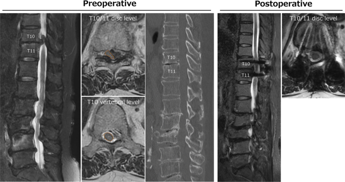 Differences In Clinical And Radiological Features Of Thoracic Disc Herniation Presenting With Acute Progressive Myelopathy Springerlink