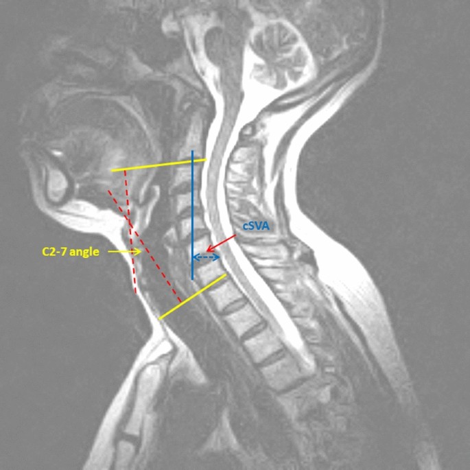 Impact Of Cervical Sagittal Balance And Cervical Spine Alignment On Craniocervical Junction Motion An Analysis Using Upright Multi Positional Mri Springerlink