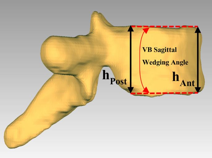 شكل الفقرات واعوجاج العمود الفقري