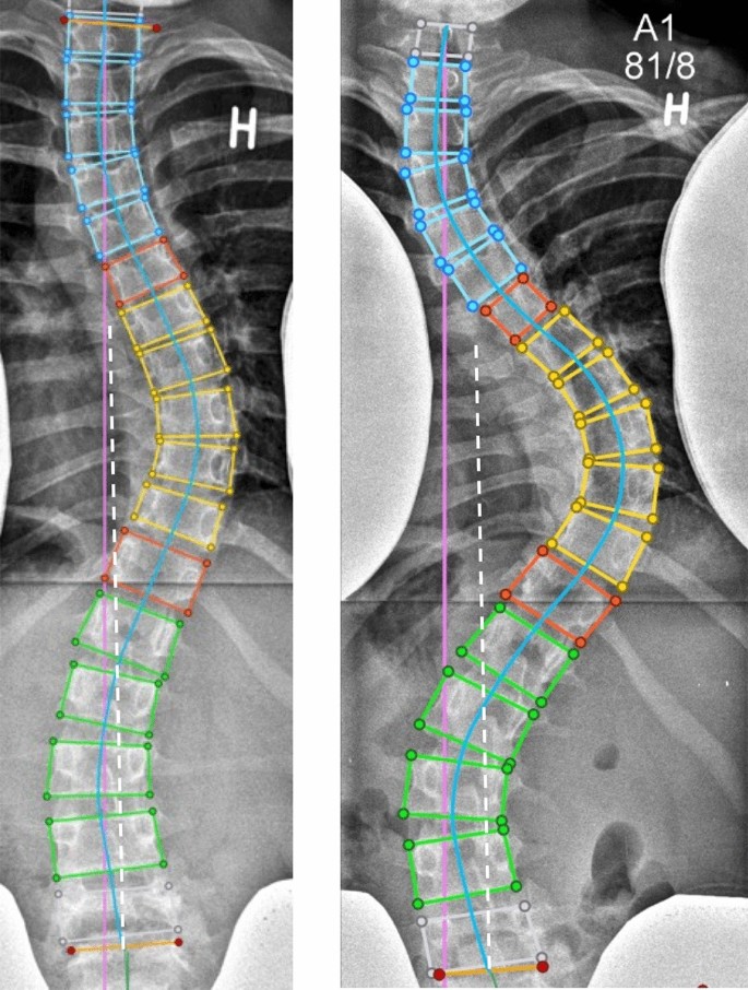 متى يكون الوزن الزائد عامل خطر حقيقي على اعوجاج العمود الفقري؟