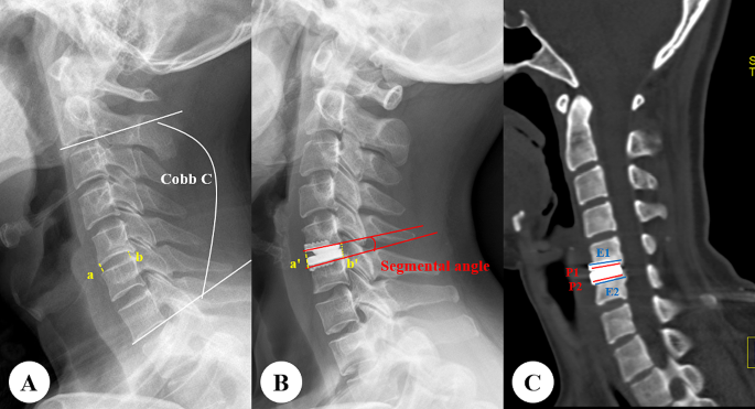Artificial intelligence in predicting postoperative heterotopic ...