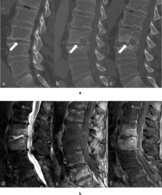 What is the Treatment for Vacuum Disc Phenomenon: Effective Solutions Revealed