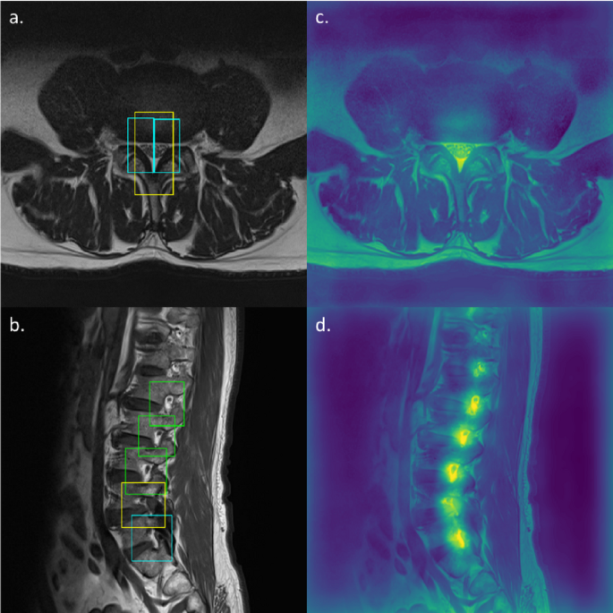 Deep learning models for lumbar spinal stenosis on MRI: model ...