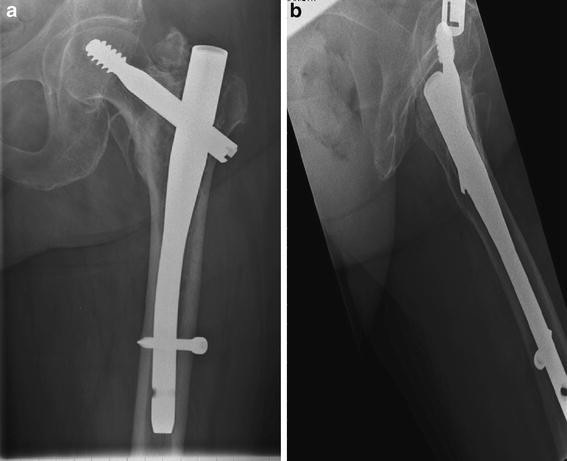 Short gamma nail fixation for intertrochanteric fractures in the elderly |  SpringerLink