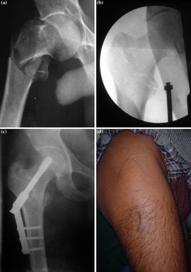Modified minimally invasive approach for dynamic hip screw fixation |  SpringerLink