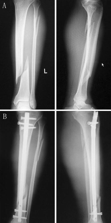 Spiral Fracture: Healing Time, Tibia, and Fibula