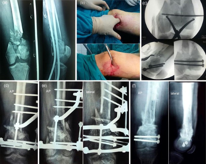 Full ring external fixation (Ilizarov) for Extraarticular, wedge fracture