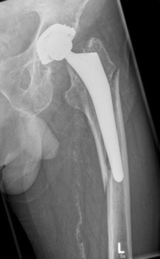 Outcome Of Periprosthetic Femoral Fractures Following Total Hip Replacement  Treated With Polyaxial Locking Plate | Springerlink
