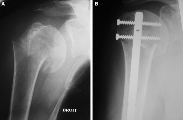 Proximal humerus fractures: editorial | SpringerLink