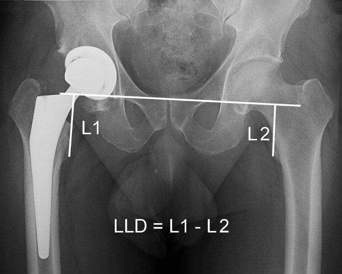 Patient-Dependent Risk Factors For Self-Perceived Leg Length Discrepancy  After Total Hip Arthroplasty | Springerlink