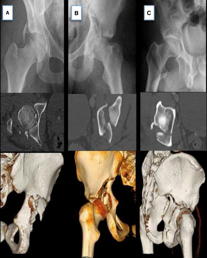 The role of patient positioning on the outcome of acetabular fractures  fixation through the Kocher–Langenbeck approach | SpringerLink