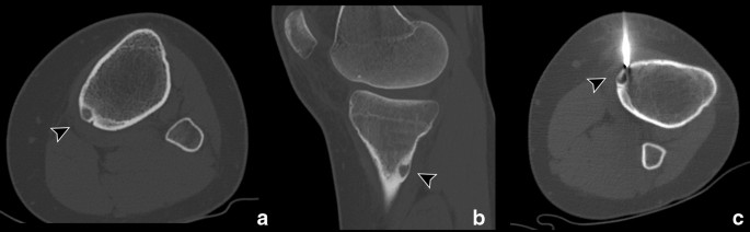 Osteoid Osteoma Which Is The Best Mininvasive Treatment Option Springerlink