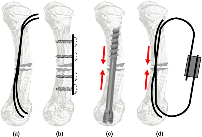 Intramedullary percutaneous fixation of metacarpal fractures: screw versus  connected K-wires | SpringerLink