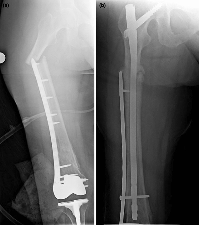 Surgery Nursery school Pets Peri-implant fractures of the upper and lower extremities: a case series of  61 fractures | SpringerLink