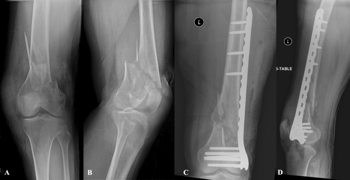 Distal femoral replacement versus ORIF for severely comminuted distal femur  fractures | SpringerLink