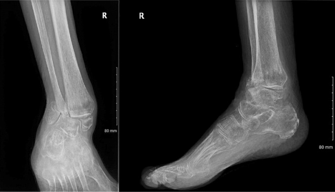 Ankle fusion with tibiotalocalcaneal retrograde nail for fragility ankle fractures: outcomes at a major trauma centre | SpringerLink Ankle fusion with tibiotalocalcaneal retrograde nail for fragility ankle fractures: outcomes at a major trauma centre | SpringerLink
