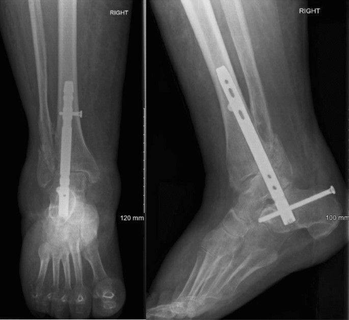 Ankle fusion with tibiotalocalcaneal retrograde nail for fragility ankle  fractures: outcomes at a major trauma centre | SpringerLink