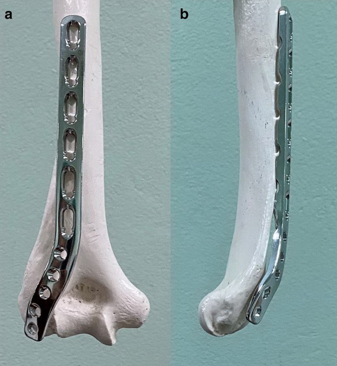 Minimally invasive plate osteosynthesis via posterior approach for type B  and C fractures of distal humeral shaft: surgical tactics and a clinical  series | SpringerLink