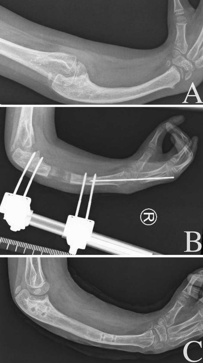 Club Hand  International Center for Limb Lengthening