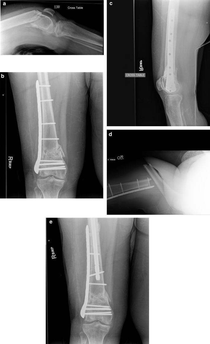 Early peri-implant fractures after distal femur fracture locked plating? |  SpringerLink