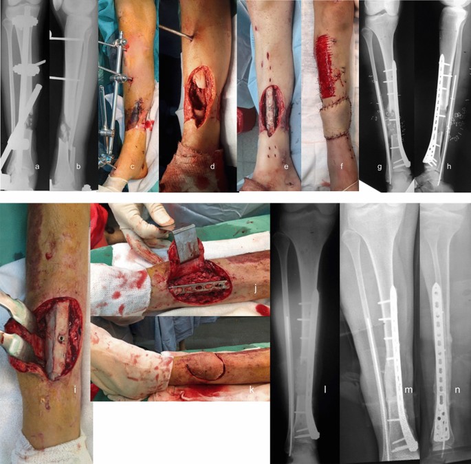 Fracture-Related Infection of the tibia due to a polymicrobial