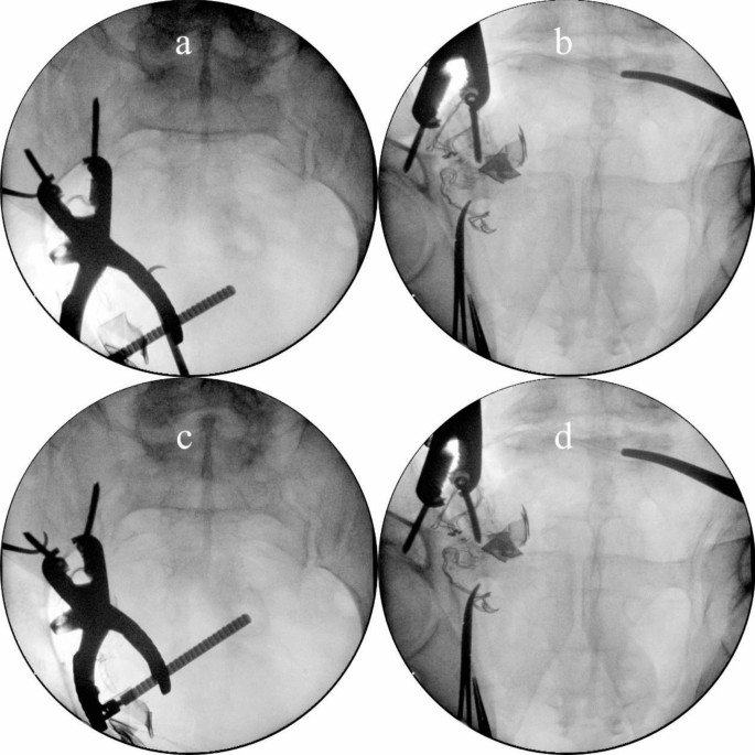 Association between sacroiliac joint reduction quality and acetabular ...
