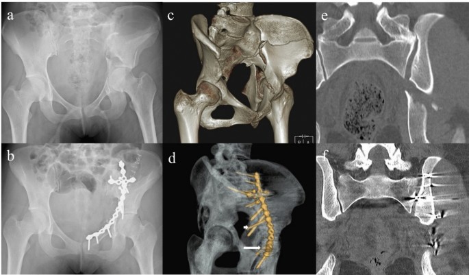 Association between sacroiliac joint reduction quality and acetabular ...