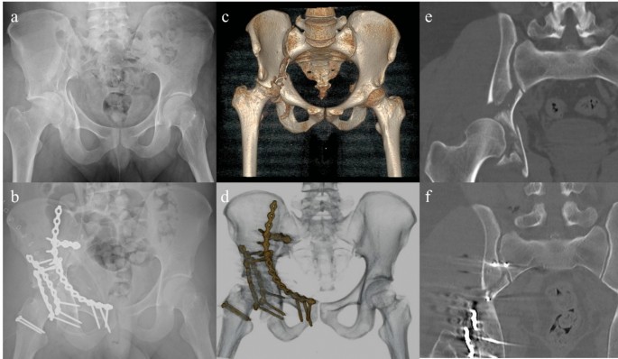 Association between sacroiliac joint reduction quality and acetabular ...