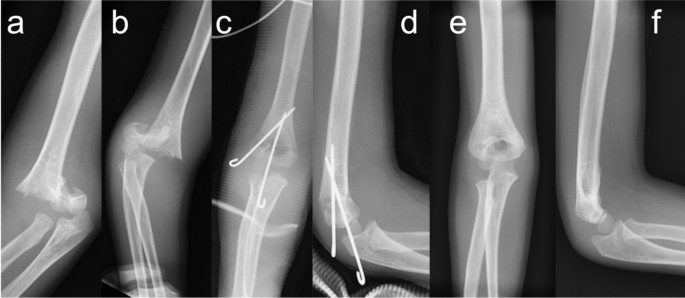 Condyle Pin Elbow Percutaneous pinning through the elbow joint versus cross-pinning for ...