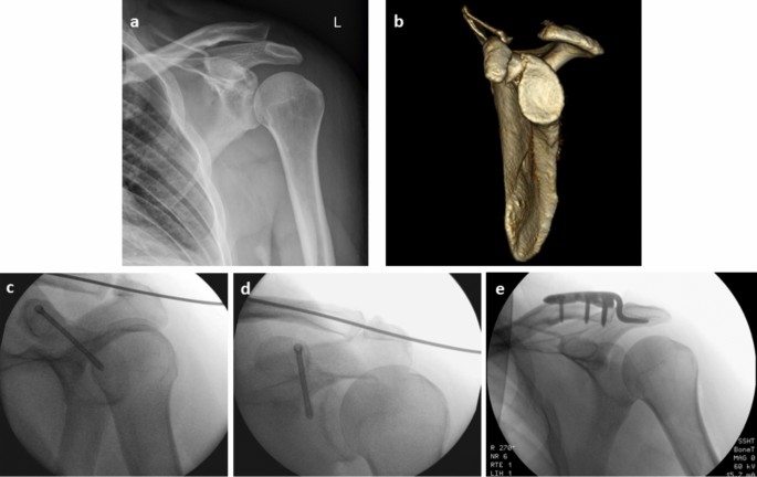 Coracoid fractures: long-term results and modification of the ...