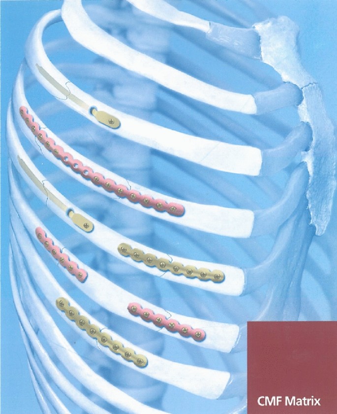 Two-center retrospective study comparing intramedullary and plate ...
