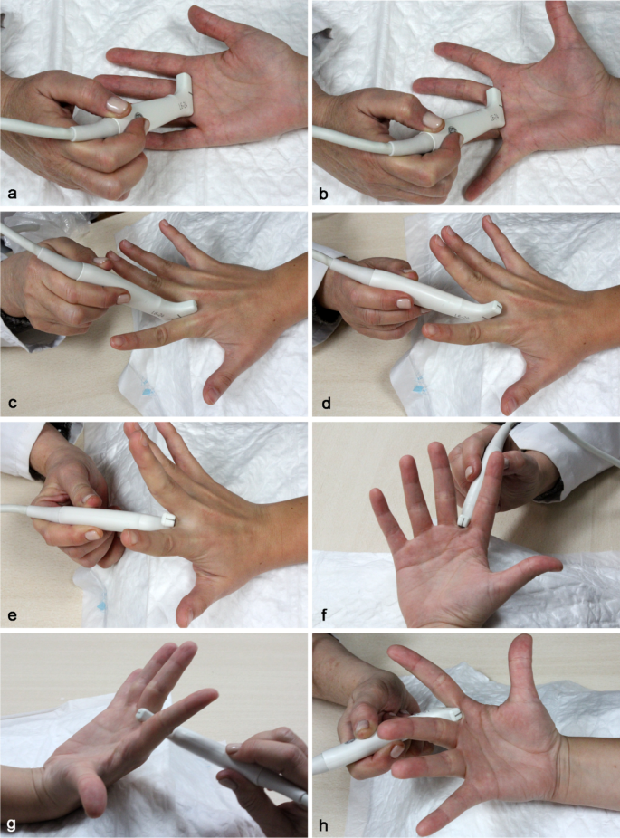 The superficial transverse metacarpal ligament and the interdigital web ...
