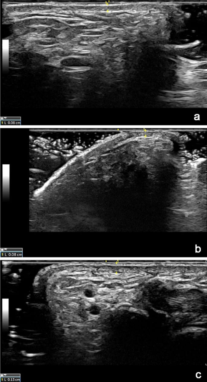 The superficial transverse metacarpal ligament and the interdigital web ...