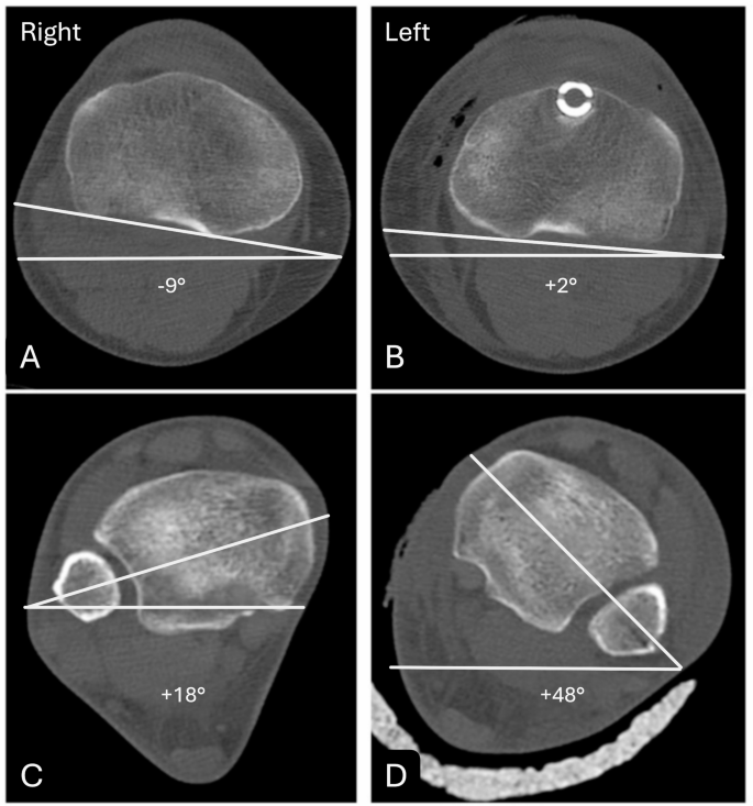 Tibial Rotation Surgery There is no difference in prevalence of rotation malalignment following ...