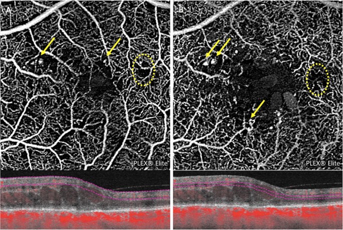 Profile Of Non Responder And Late Responder Patients Treated For Diabetic Macular Edema Systemic And Ocular Factors Springerlink