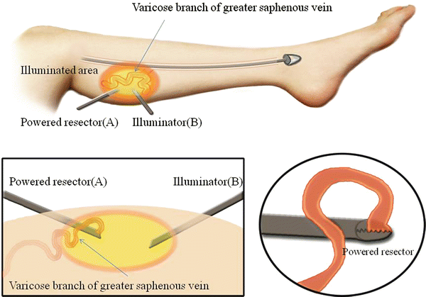 varicose phlebectomy recenzii